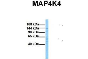 Host:  Rabbit  Target Name:  MAP4K4  Sample Tissue:  Human Stomach Tumor  Antibody Dilution:  1. (MAP4K4 Antikörper  (N-Term))