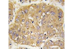 IHC analysis of FFPE human hepatocarcinoma tissue stained with IGFBP3 antibody (IGFBP3 Antikörper  (AA 163-193))