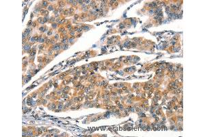 Immunohistochemistry of Human breast cancer using STK17A  Polyclonal Antibody at dilution of 1:25 (STK17A Antikörper)