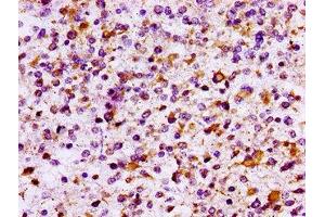 IHC image of ABIN7156768 diluted at 1:100 and staining in paraffin-embedded human glioma performed on a Leica BondTM system. (IL1R2 Antikörper  (AA 79-219))