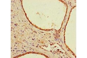 Immunohistochemistry of paraffin-embedded human prostate cancer using ABIN7142194 at dilution of 1:100 (26S Proteasome Complex Subunit SEM1 (SEM1) (AA 1-70) Antikörper)