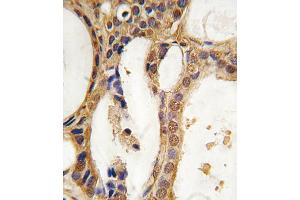 Formalin-fixed and paraffin-embedded human prostata carcinoma tissue reacted with PIM1 antibody, which was peroxidase-conjugated to the secondary antibody, followed by DAB staining. (PIM1 Antikörper)