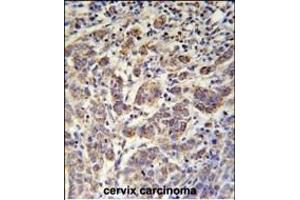 ANKRD57 Antibody (C-term) (ABIN651987 and ABIN2840483) immunohistochemistry analysis in formalin fixed and paraffin embedded human cervix carcinoma followed by peroxidase conjugation of the secondary antibody and DAB staining. (ANKRD57 Antikörper  (C-Term))