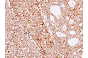 IHC-P Image Immunohistochemical analysis of paraffin-embedded Serous OVCA xenograft, using THUMPD3, antibody at 1:100 dilution. (THUMPD3 Antikörper)