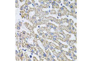 Immunohistochemistry of paraffin-embedded human liver damage using SDC2 antibody (ABIN3022587, ABIN3022588, ABIN3022589 and ABIN6218928) at dilution of 1:100 (40x lens). (Syndecan 2 Antikörper  (AA 19-144))