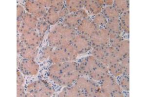 IHC-P analysis of Human Stomach Cancer Tissue, with DAB staining. (FGF19 Antikörper  (AA 4-216))