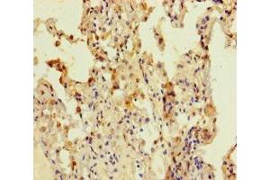 Immunohistochemistry of paraffin-embedded human lung cancer using ABIN7148108 at dilution of 1:100 (C12ORF68 Antikörper  (AA 1-194))