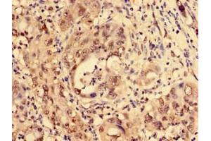 Immunohistochemistry of paraffin-embedded human liver cancer using ABIN7158369 at dilution of 1:100 (LIM Domain Binding 1 Protein Antikörper  (AA 50-375))