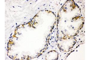 Anti- CD46 Picoband antibody, IHC(P) IHC(P): Human Prostatic Cancer Tissue (CD46 Antikörper  (C-Term))