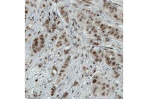 Immunohistochemical staining (Formalin-fixed paraffin-embedded sections) of human breast cancer with WHSC1 monoclonal antibody, clone CL1057  shows moderate nuclear immunoreactivity in tumor cells. (WHSC1 Antikörper)