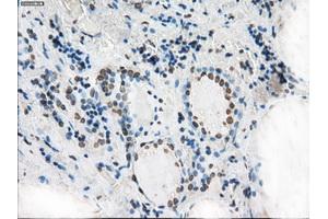 Immunohistochemical staining of paraffin-embedded Adenocarcinoma of colon tissue using anti-XRCC4mouse monoclonal antibody.