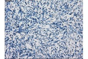 Immunohistochemical staining of paraffin-embedded Adenocarcinoma of breast tissue using anti-KDM4C mouse monoclonal antibody. (KDM4C Antikörper)
