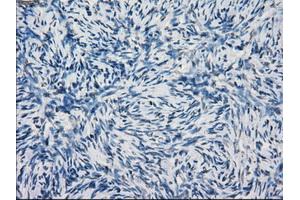 Immunohistochemical staining of paraffin-embedded Adenocarcinoma of breast tissue using anti-KDM4C mouse monoclonal antibody. (KDM4C Antikörper)