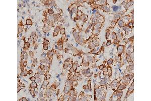 ABIN6276358 at 1/200 staining human breast cancer tissue sections by IHC-P.