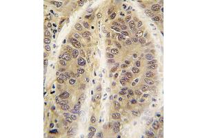 Formalin-fixed and paraffin-embedded human hepatocarcinoma tissue reacted with ADK antibody (C-term) (ABIN391132 and ABIN2841255) , which was peroxidase-conjugated to the secondary antibody, followed by DAB staining. (ADK Antikörper  (C-Term))