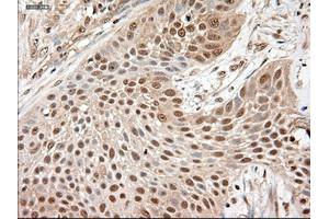 Immunohistochemical staining of paraffin-embedded Adenocarcinoma of breast using anti-NTF3 (ABIN2452548) mouse monoclonal antibody.