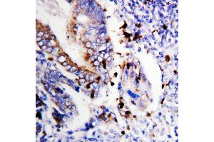 Anti-Bcl-XS antibody, IHC(P) IHC(P): Human Colon Cancer Tissue (BCL2L1 Antikörper  (Middle Region))