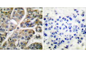 Peptide - +Immunohistochemical analysis of paraffin-embedded human breast carcinoma tissue using Granzyme B antibody (#C0215). (GZMB Antikörper)
