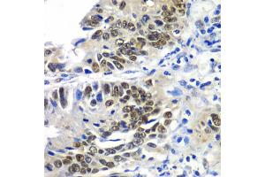 Immunohistochemistry of paraffin-embedded human colon carcinoma using DACH1 antibody (ABIN5972012) at dilution of 1/100 (40x lens). (DACH1 Antikörper)