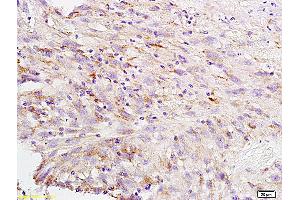 Formalin-fixed and paraffin embedded human brain glioblastoma labeled with Anti-CA II Polyclonal Antibody, Unconjugated (ABIN733298) at 1:200 followed by conjugation to the secondary antibody and DAB staining (CA2 Antikörper  (AA 201-260))