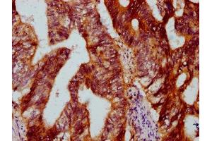 IHC image of ABIN7150800 diluted at 1:500 and staining in paraffin-embedded human colon cancer performed on a Leica BondTM system.