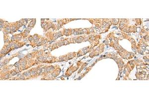Immunohistochemistry of paraffin-embedded Human thyroid cancer tissue using CCL5 Polyclonal Antibody at dilution of 1:50(x200)