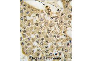 Formalin-fixed and paraffin-embedded human breast carcinoma tissue reacted with the MDM2 Antibody (S166) , which was peroxidase-conjugated to the secondary antibody, followed by DAB staining.