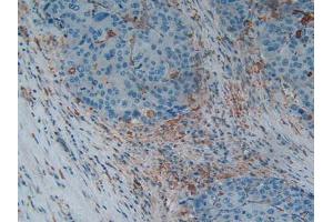 IHC-P analysis of Human Liver Cancer Tissue, with DAB staining. (Gelsolin Antikörper  (AA 674-782))