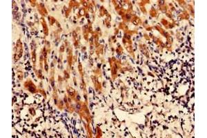 Immunohistochemistry analysis of human liver cancer using ABIN7147768 at dilution of 1:100 (CFAP61 Antikörper  (AA 1-200))