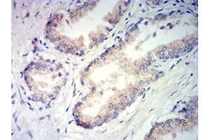 Immunohistochemical analysis of paraffin-embedded prostate tissues using PSAP mouse mAb with DAB staining. (Prosaposin Antikörper  (AA 17-216))