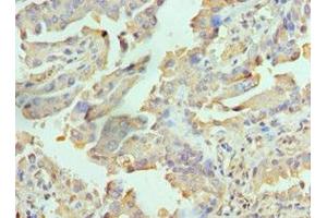 Immunohistochemistry of paraffin-embedded human lung cancer using ABIN7167113 at dilution of 1:100 (RICTOR Antikörper  (AA 1-245))