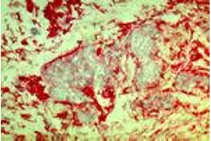 Invasive mammary carcinoma cells (MAb DF5, b1-Integrin) (ITGB1 Antikörper)