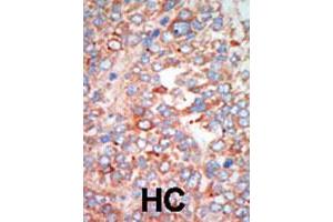 Formalin-fixed and paraffin-embedded human hepatocellular carcinoma tissue reacted with the STK24 polyclonal antibody  , which was peroxidase-conjugated to the secondary antibody, followed by AEC staining. (STK24 Antikörper  (C-Term))