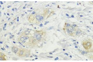 Immunohistochemistry of paraffin-embedded Human liver cancer using SURF4 Polyclonal Antibody at dilution of 1:200 (40x lens). (Surfeit 4 Antikörper)
