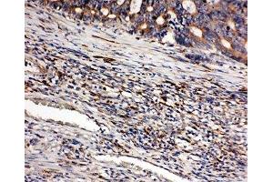 IHC-P: CD163 antibody testing of human intestinal cancer tissue (CD163 Antikörper  (AA 1056-1165))
