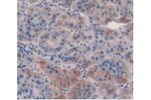 IHC-P analysis of Human Liver Cancer Tissue, with DAB staining. (GDF5 Antikörper  (AA 86-501))