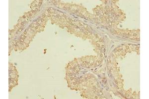 Immunohistochemistry of paraffin-embedded human prostate cancer using ABIN7164073 at dilution of 1:100 (PQLC3 Antikörper  (AA 118-170))