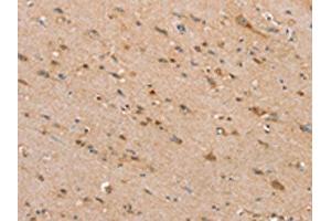 The image on the left is immunohistochemistry of paraffin-embedded Human brain tissue using ABIN7192440(SLC25A20 Antibody) at dilution 1/30, on the right is treated with synthetic peptide. (SLC25A2 Antikörper)