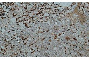 Immunohistochemistry of paraffin-embedded Human colon tissue using Galectin 3 Monoclonal Antibody at dilution of 1:50. (Galectin 3 Antikörper)