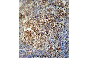 MAF1 antibody immunohistochemistry analysis in formalin fixed and paraffin embedded human lung carcinoma followed by peroxidase conjugation of the secondary antibody and DAB staining.