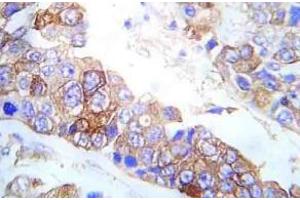 Immunohistochemistry analysis of Fyn antibody pTyr530 in paraffin-embedded Human breast carcinoma tissue. (FYN Antikörper  (pTyr530))