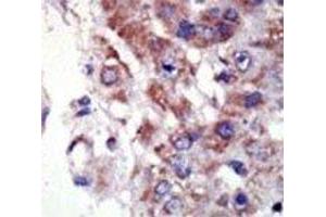 IHC analysis of FFPE human hepatocarcinoma tissue stained with the JNK2 antibody (JNK2 Antikörper  (AA 349-379))