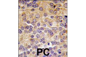 Formalin-fixed and paraffin-embedded human prostate carcinoma tissue reacted with PRMT3 polyclonal antibody  , which was peroxidase-conjugated to the secondary antibody, followed by DAB staining. (PRMT3 Antikörper  (N-Term))