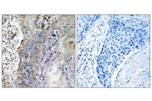 Immunohistochemistry analysis of paraffin-embedded human lung carcinoma tissue, using SLC28A2 antibody. (SLC28A2 Antikörper  (Internal Region))