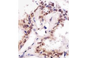 (ABIN387785 and ABIN2838022) staining SUMO1 in human lung adenocarcinoma tissue sections by Immunohistochemistry (IHC-P - paraformaldehyde-fixed, paraffin-embedded sections). (SUMO1 Antikörper)
