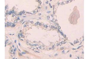 Used in DAB staining on fromalin fixed paraffin- embedded rectum cancer tissue (IL1R1 Antikörper  (AA 226-318))