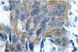 Immunohistochemistry (IHC) analyzes of p-Catenin-beta antibody in paraffin-embedded human colon carcinoma tissue. (CTNNB1 Antikörper  (pSer33))