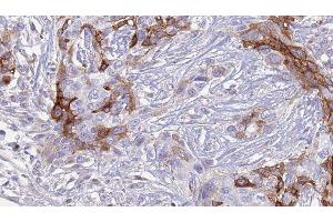ABIN6277346 at 1/100 staining Human urothelial cancer tissue by IHC-P. (SLC18A2 Antikörper  (C-Term))