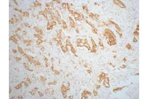 Immunohistochemistry (IHC) staining of Mouse prostate adenocarcinoma tissue, diluted at 1:200. (AMACR Antikörper)