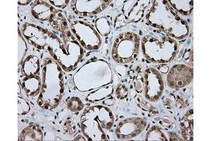 Immunohistochemical staining of paraffin-embedded Carcinoma of liver tissue using anti-NME4 mouse monoclonal antibody. (NME4 Antikörper)